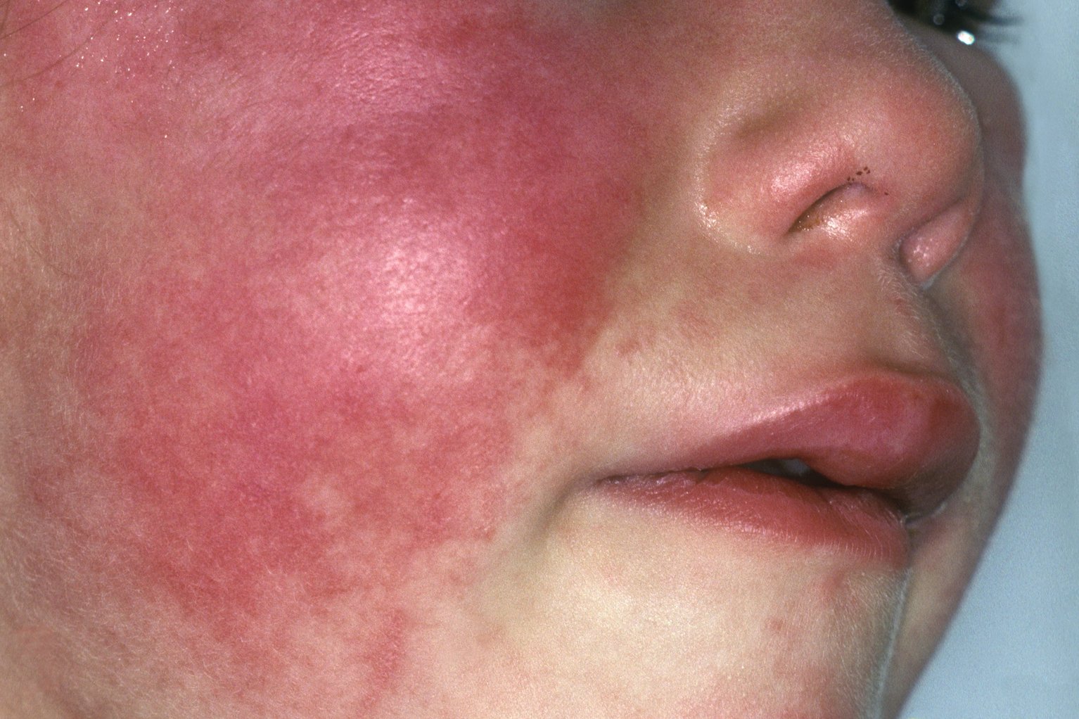 Scarlet Fever Virus Or Bacteria