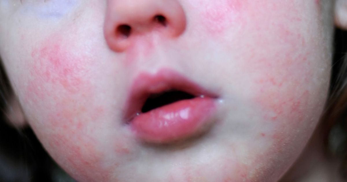 strep rash on face