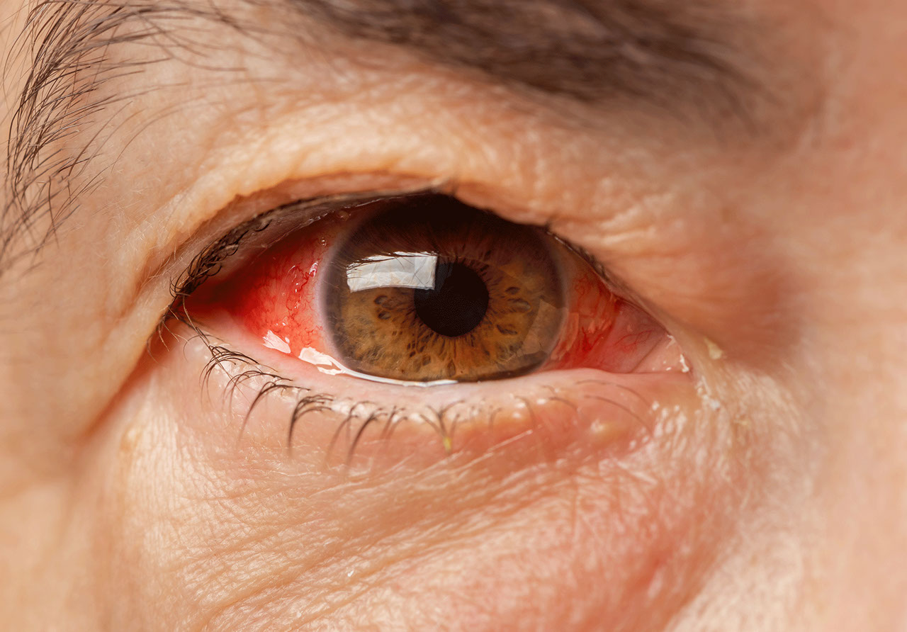 What Is Glaucoma?