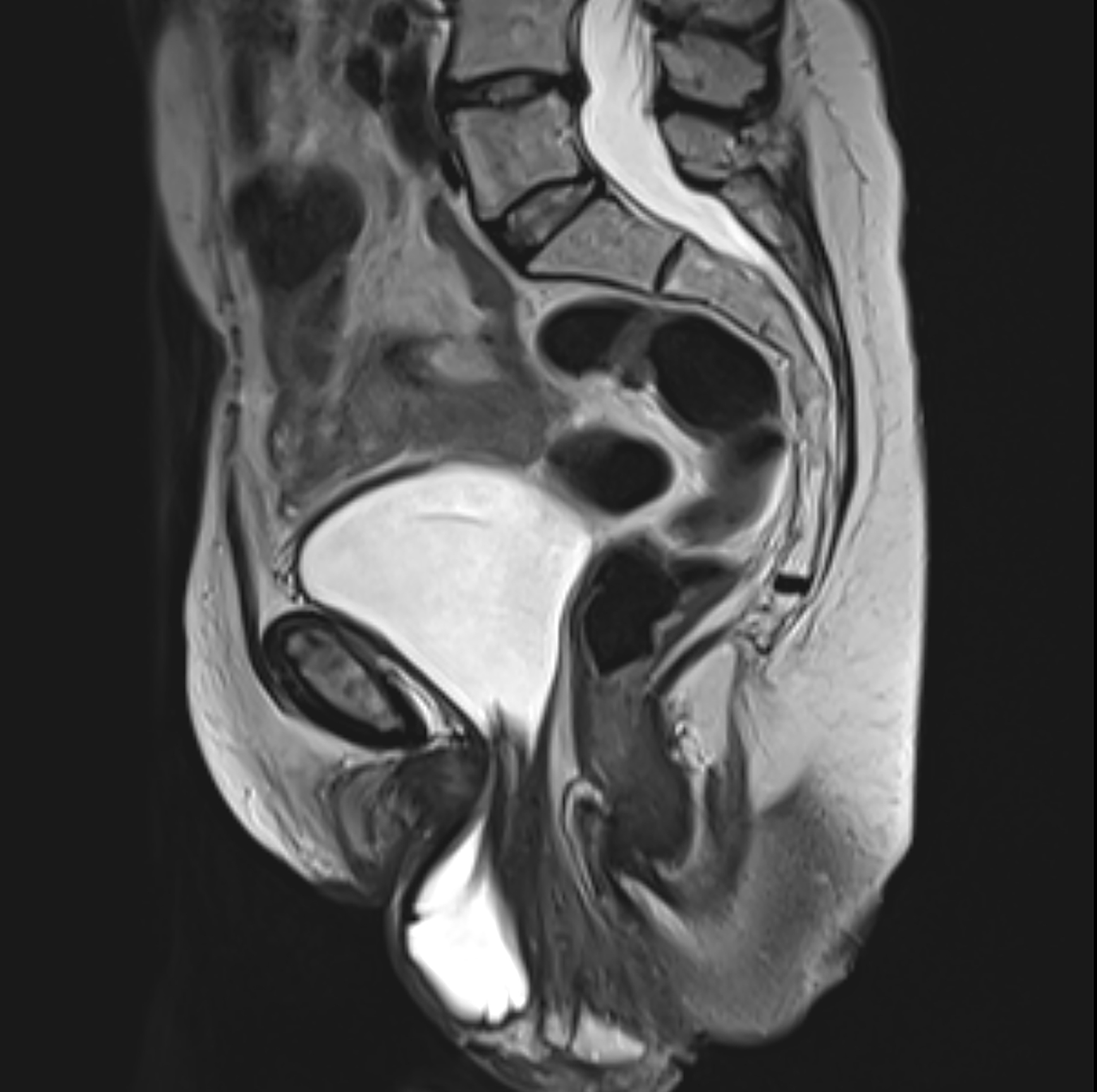 Treating Pelvic Organ Prolapse Without Surgery YourCareEverywhere