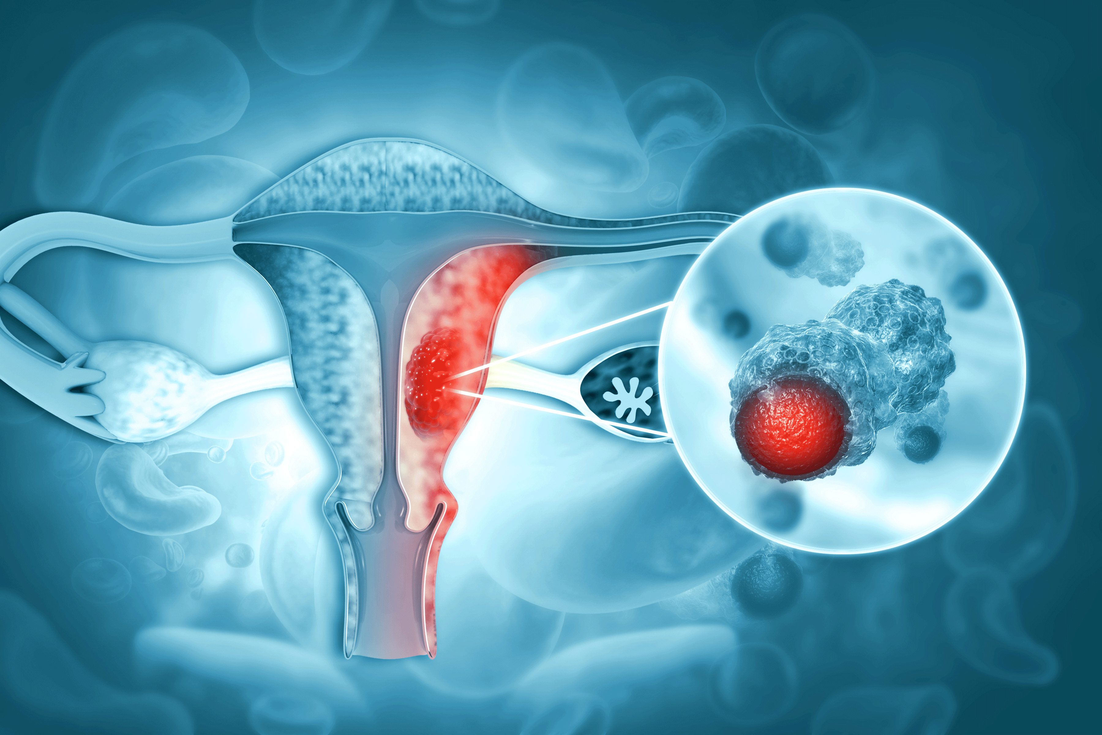 Endometrial Cancer Symptoms | YourCareEverywhere