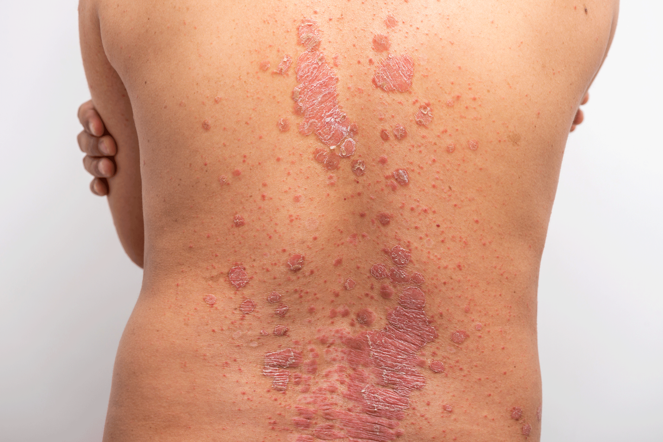 What Is Eczema? | YourCareEverywhere