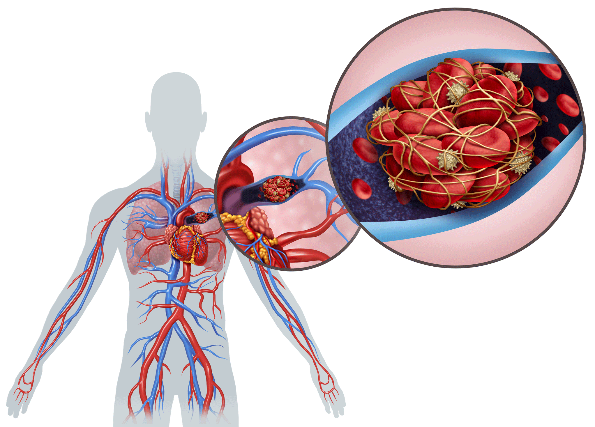 How To Say Pulmonary Embolism In French