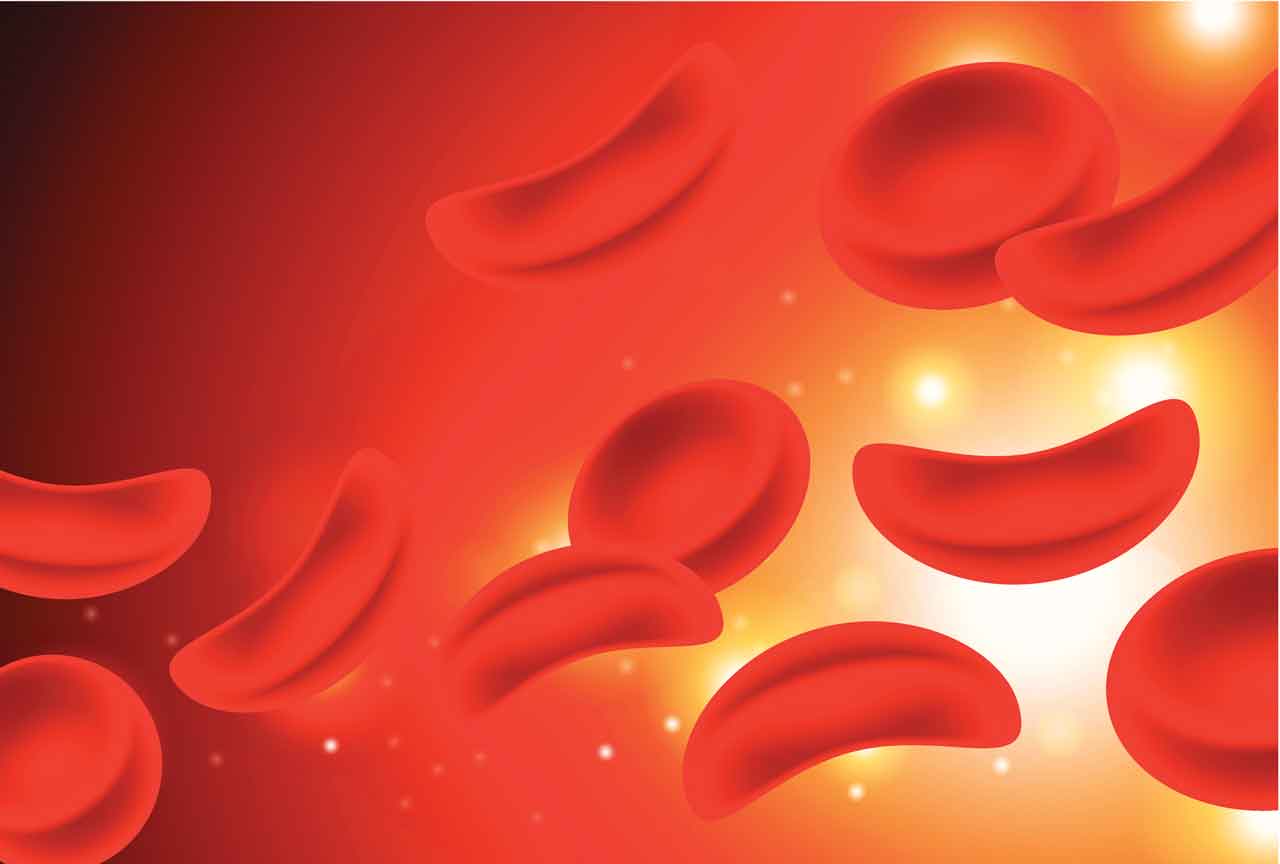 What Is Sickle Cell Anemia Wikipedia