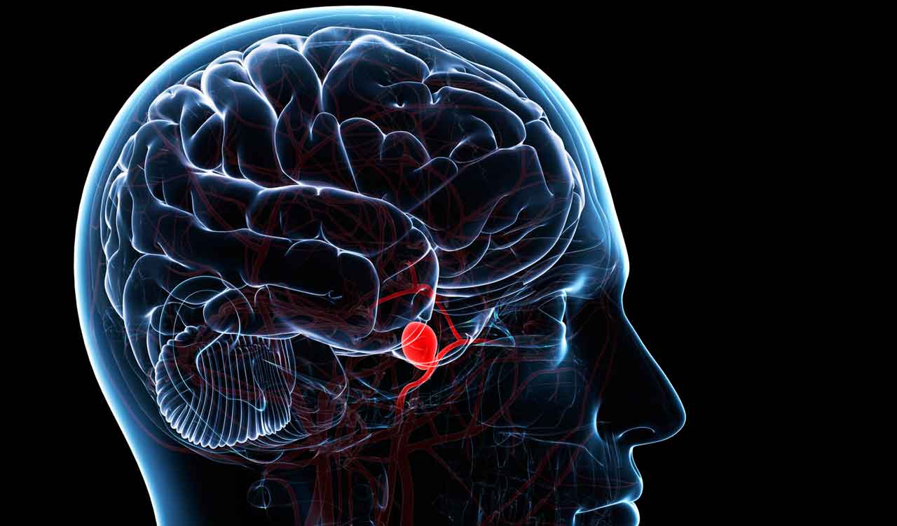 brain-aneurysm-symptoms-yourcareeverywhere