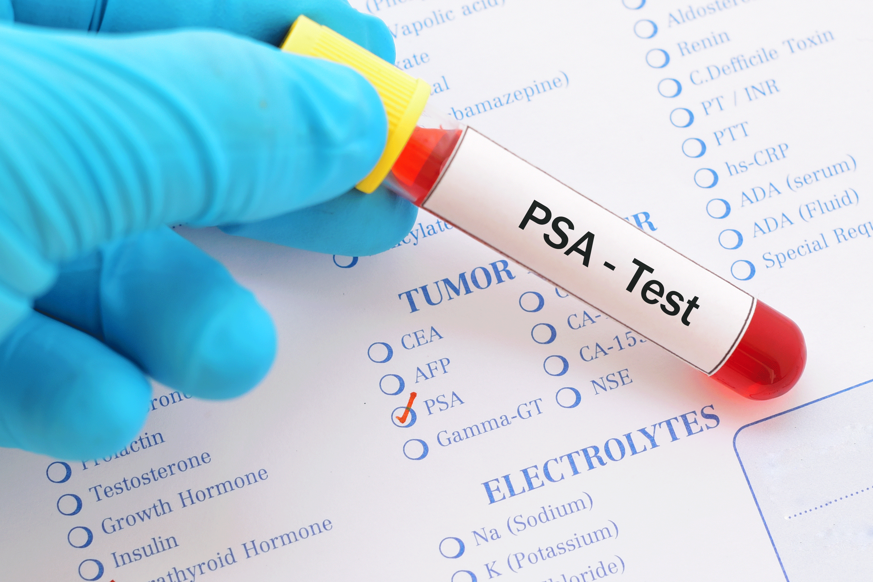 What Are The Psa Levels For Prostate Cancer