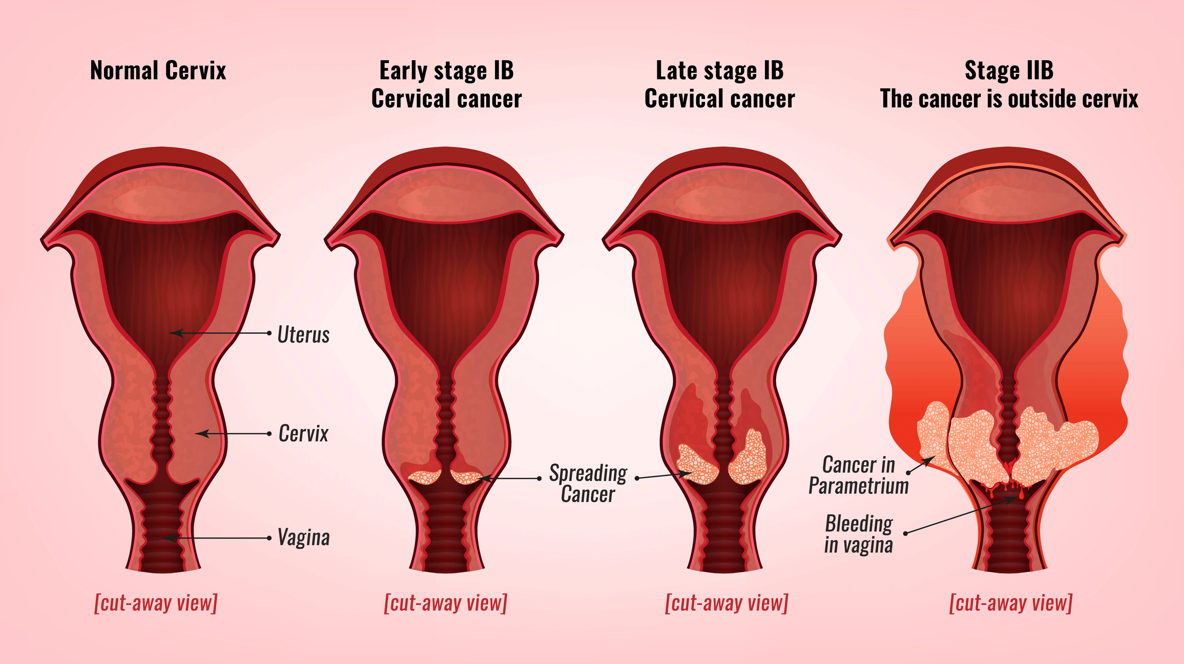 Can Cervical Cancer Cause Breast Cancer