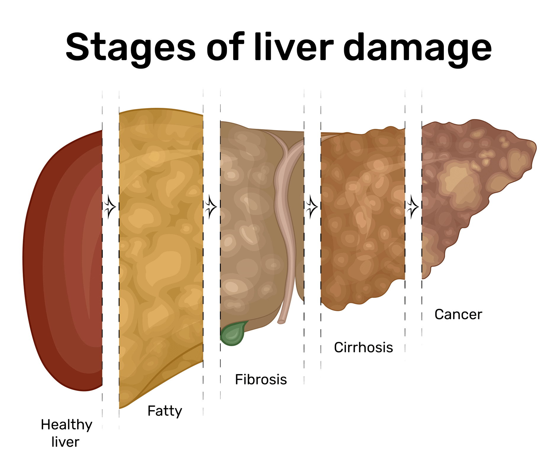 Reversing Nonalcoholic Liver Disease | YourCareEverywhere