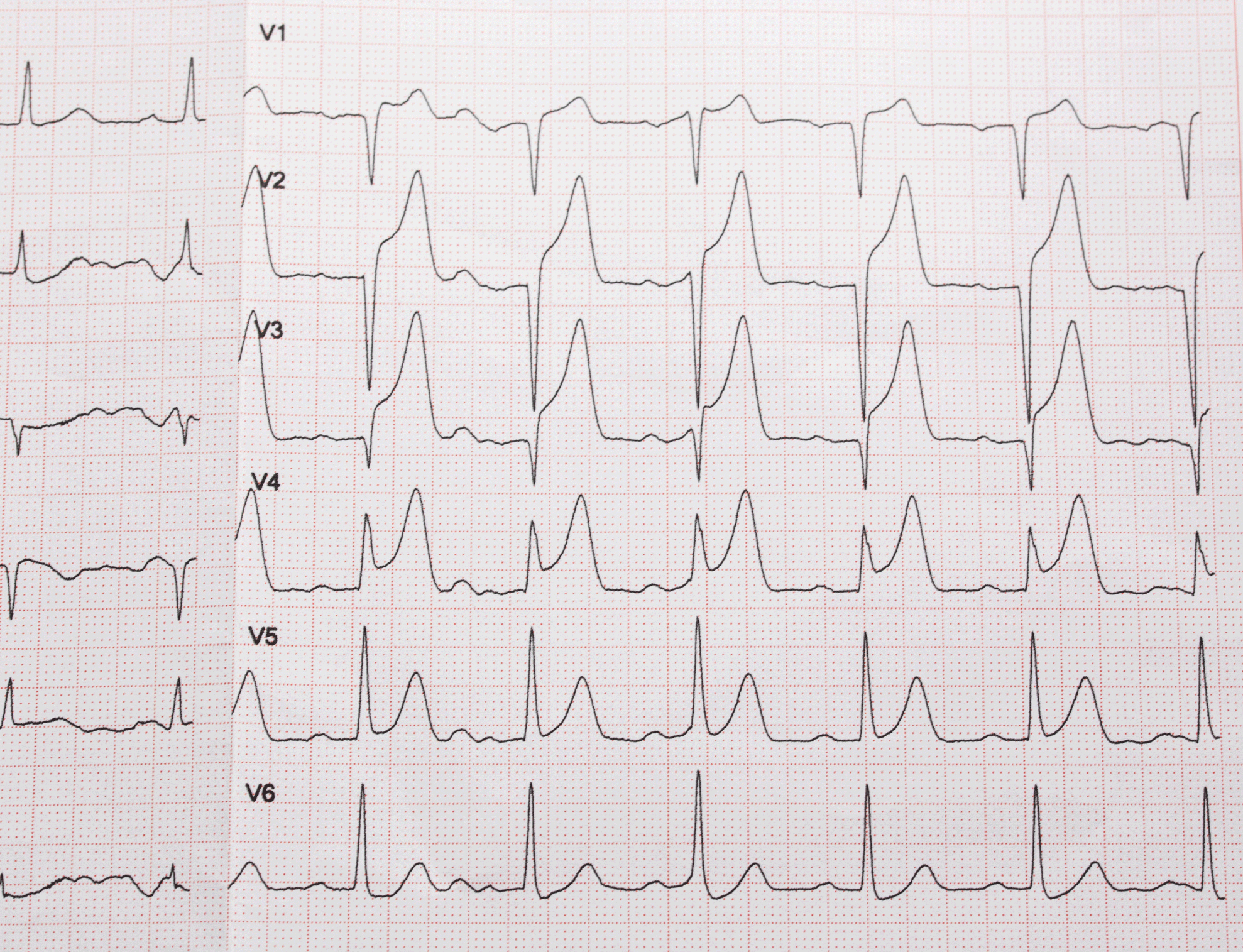 What Is Ventricular Fibrillation Nhs