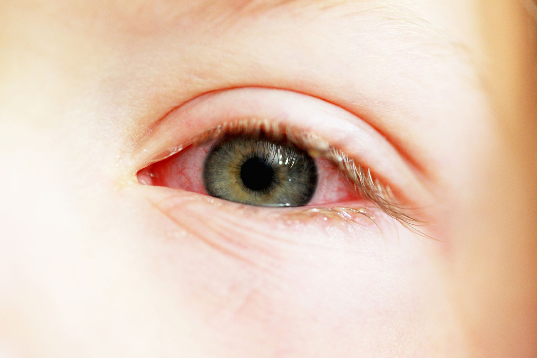 how-long-is-pink-eye-contagious-yourcareeverywhere