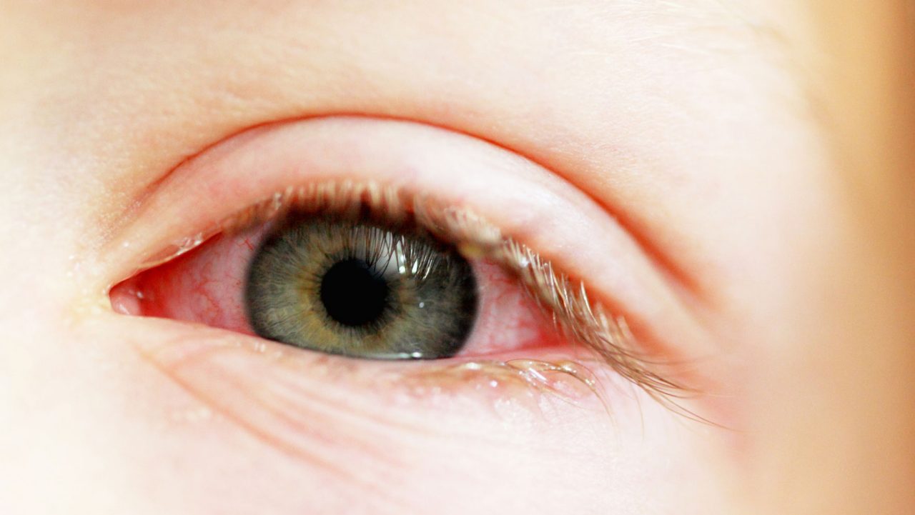 How Long Is Pink Eye Contagious?