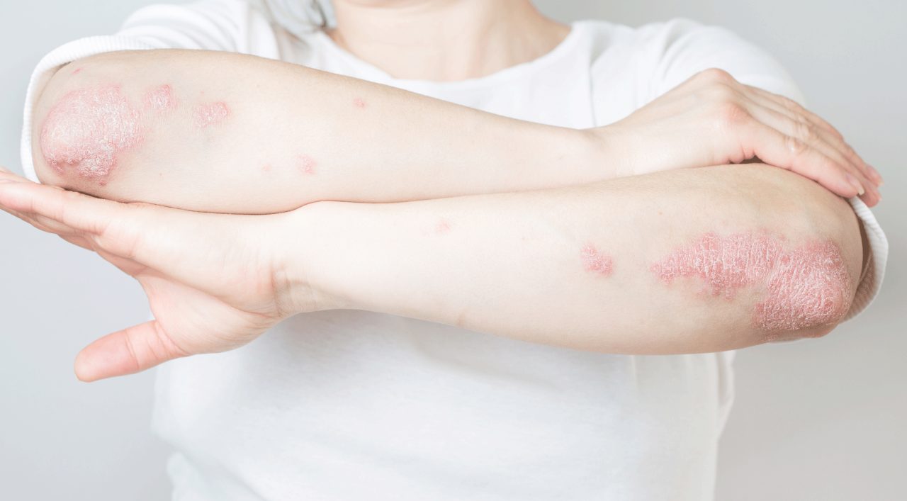 Treating Psoriasis May Help You Avoid Dementia 