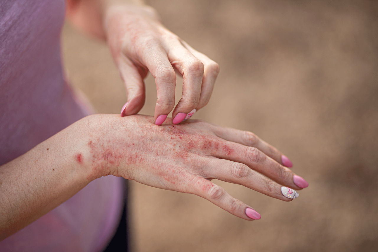 What Is Dermatitis?